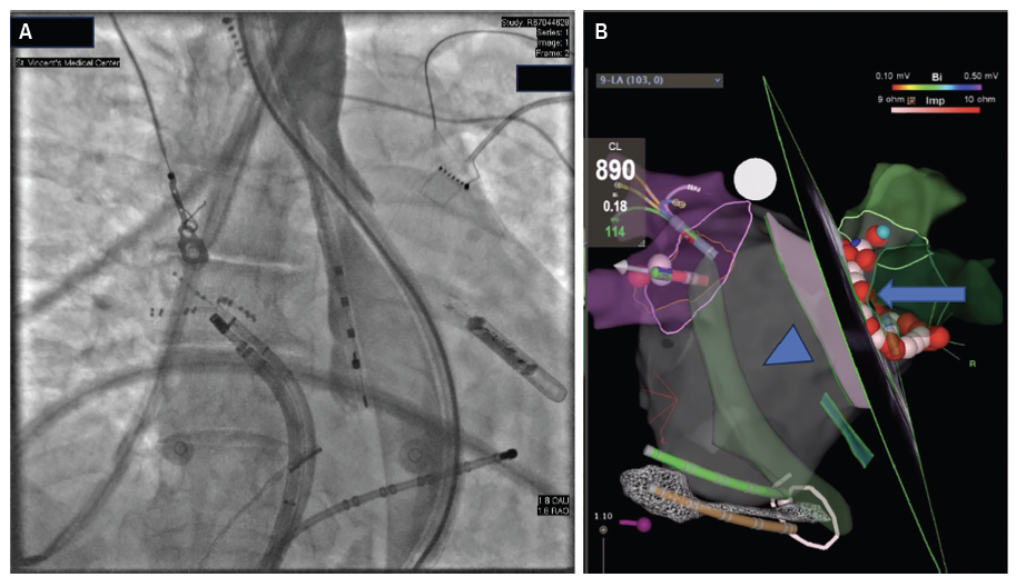 Figure 3. (A) Fluoroscopy of EsoSure deviating the esophagus to the left. (B) Arrow: contours of initial position of esophagus. Triangle: Contours of deviated esophagus.