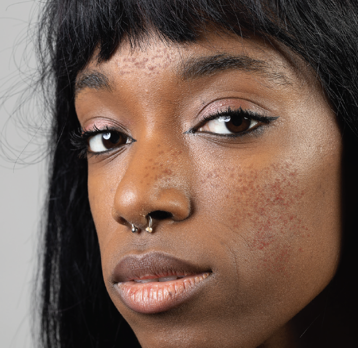 patients with rosacea