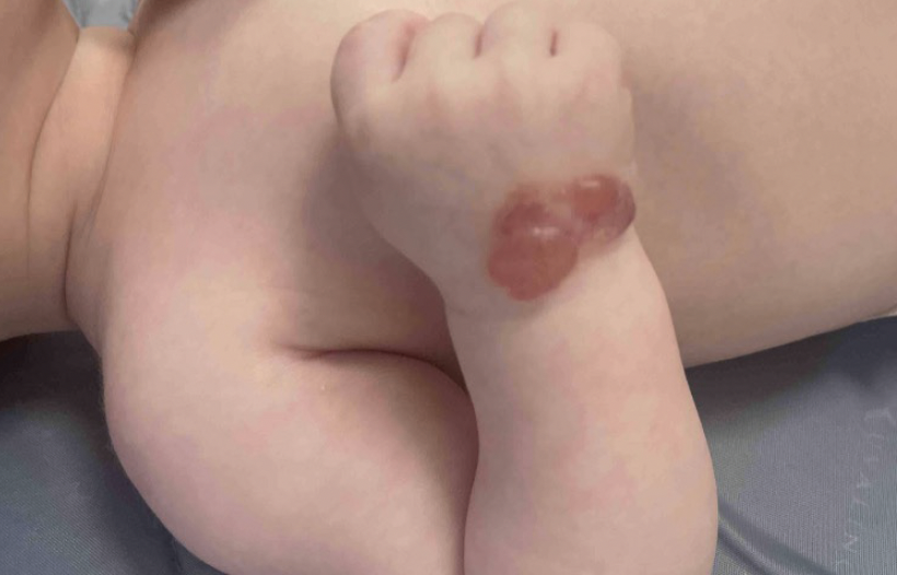 Multilobulated, reddish-brown bulla