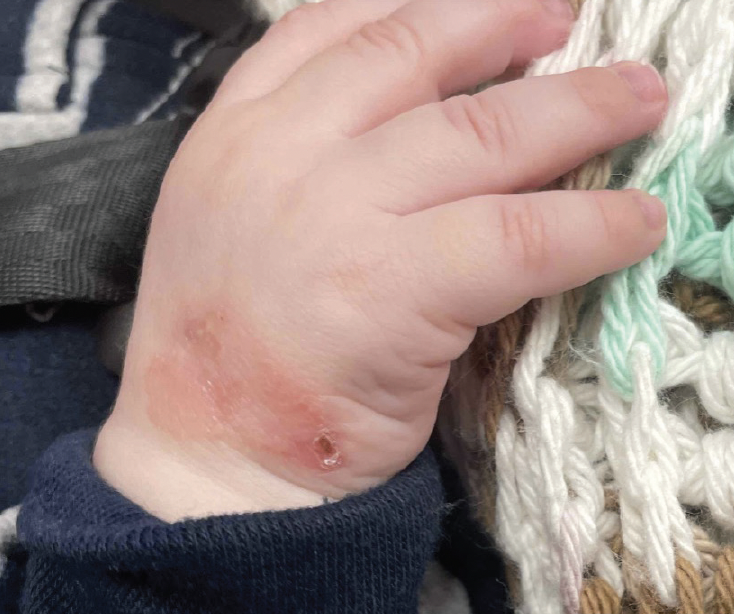 Residual pink-brown plaque