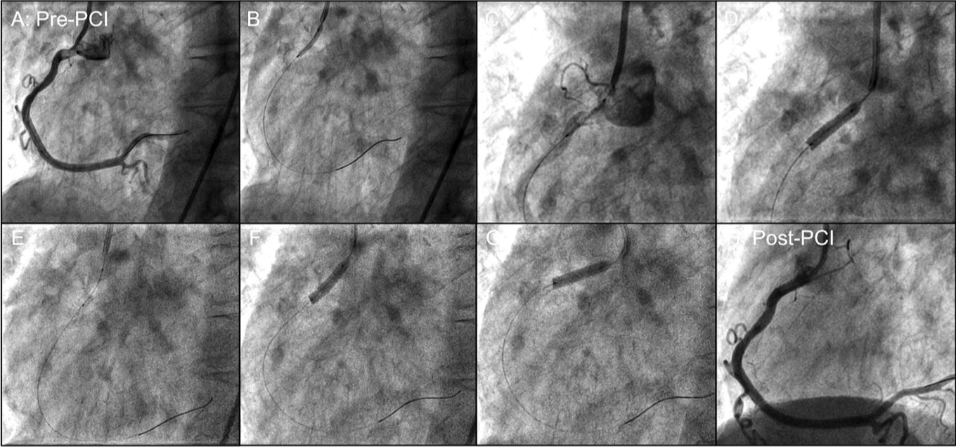 FIGURE 3. Representative example of guide-catheter manipulation during robotic percutaneous coronary intervention (PCI) of an os - tial right coronary artery (RCA) stenosis. Robotically assisted PCI of an ostial RCA lesion using the CorPath GRX system. (A) Baseline angiogram. (B) Lesion predilation. (C) Ostial stent placement with guide-catheter retraction. (D) Stent deployment. (E) Guide-catheter and stent-delivery balloon retraction. (F) Ostial stent postdilation. (G) Ostial stent flaring. (H) Final angiogram. Every step was per - formed by robotic maneuvering of the guide catheter or stent-delivery system.