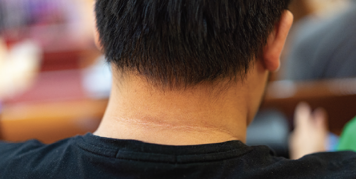 Managing Acanthosis Nigricans