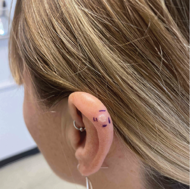 A raised exophytic, skin-colored lesion