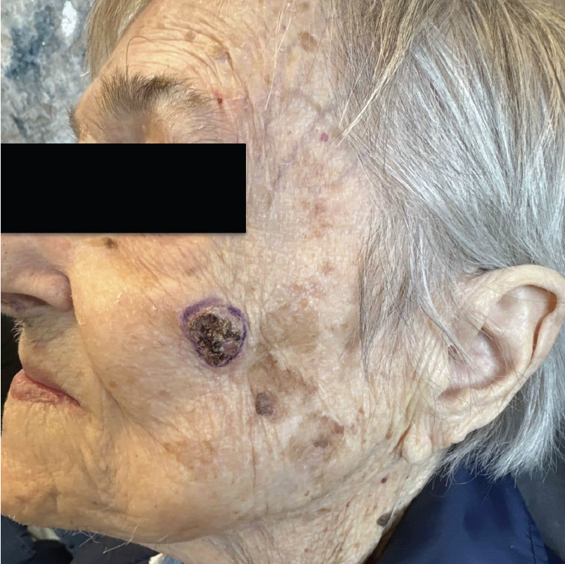 Figure 1. Erythematous scaly plaque on the left upper cheek.