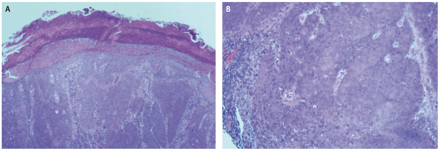 Figure 2. Clusters of neoplastic basaloid epithelial cells