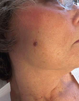 painless lesion on the right central cheek