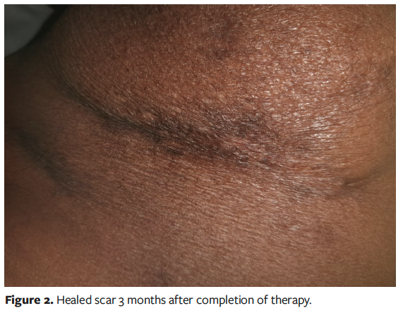 Figure 2. Healed scar 3 months after completion of therapy.