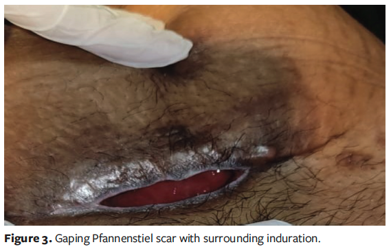 Figure 3. Gaping Pfannenstiel scar with surrounding induration.