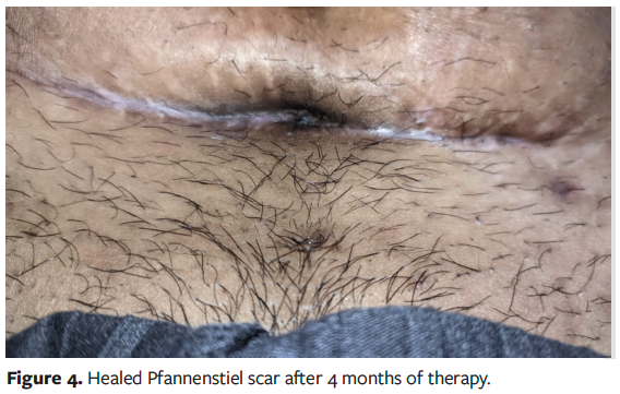 Figure 4. Healed Pfannenstiel scar after 4 months of therapy.