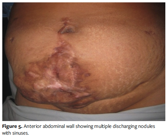Figure 5. Anterior abdominal wall showing multiple discharging nodules with sinuses.