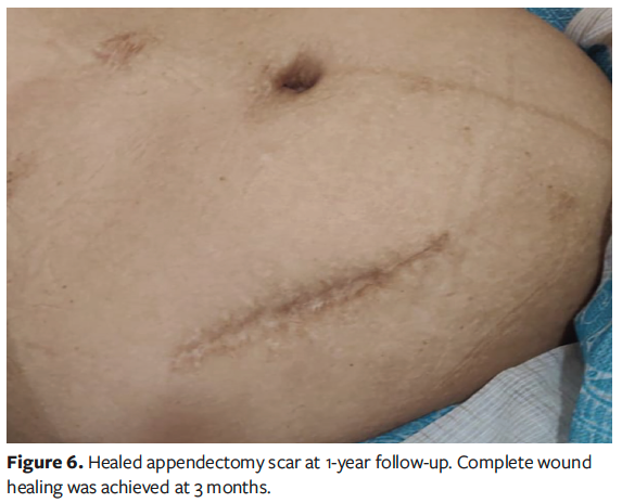 Figure 6. Healed appendectomy scar at 1-year follow-up. Complete wound healing was achieved at 3 months.