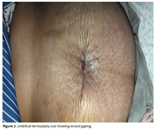 Figure 7. Umbilical hernioplasty scar showing wound gaping.