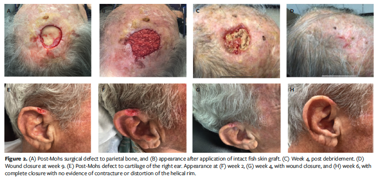Figure 2. (A) Post-Mohs surgical defect to parietal bone, and (B) appearance after application of intact fish skin graft. (C) Week 4, post debridement. (D) Wound closure at week 9. (E) Post-Mohs defect to cartilage of the right ear. Appearance at (F) week 2, (G) week 4, with wound closure, and (H) week 6, with complete closure with no evidence of contracture or distortion of the helical rim.