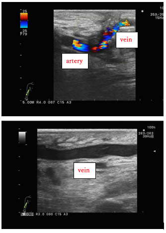 Figure 5. Ultrasound image 5 years after bypass surgery in Case 3. The anastomosis between the radial artery and the great saphenous vein is patent, and there is no stenosis in the grafted vein.