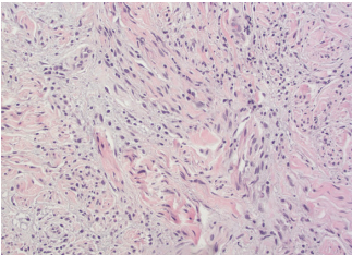 Figure 2. Histopathology with hematoxylin-eosin staining of lower left abdomen biopsy