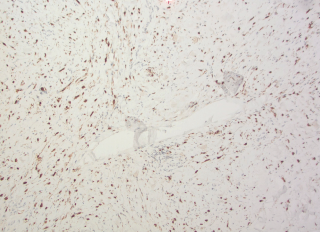 Figure 3. Histopathology with S100 staining of lower left abdomen biopsy
