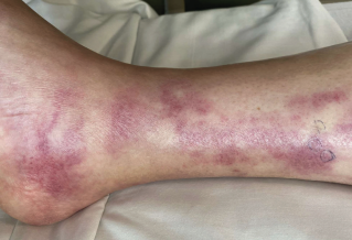 Figure 1. Scattered purpuric macules coalescing into patches on the right ankle.