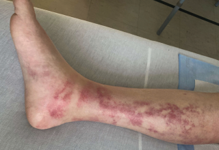 Figure 2. Scattered purpuric macules coalescing into patches on the right medial leg