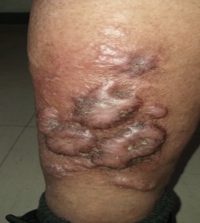 Figure. Multiple well-defined, reddish-brown, cyst-like tumors with outlying telangiectasias.