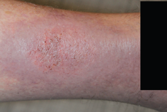 Figure 2. Resolving nummular lesion on the right ankle, 2 weeks after mupirocin monotherapy.