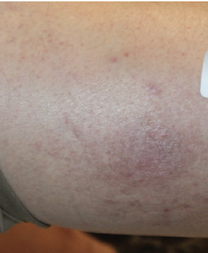 Figure 3. Near complete resolution of the nummular lesion several weeks later; the patient remained clear on emollients alone, without the need for topical corticosteroids.