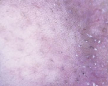 Diagnosing Demodex Follicular Overgrowth