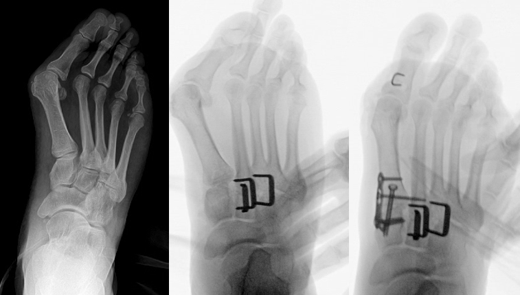 Three side by side dorsoplantar foot radiographs