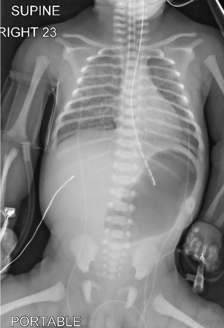 Figure 3. Abdominal radiography demonstrating marked gastric distension with paucity of distal bowel gas, consistent with pyloric atresia.