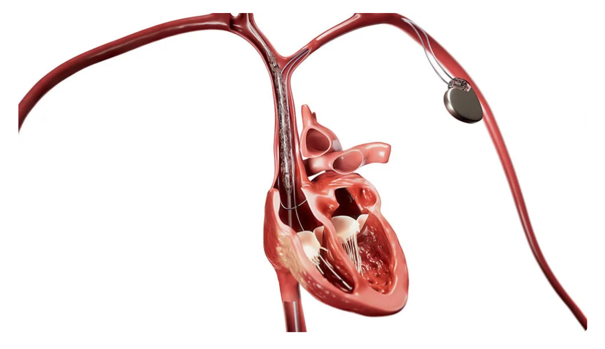 header-philips-bridge-plus-inflated-in-svc