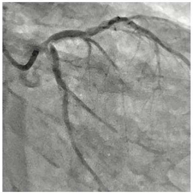 Secemsky Complex Lesions Figure 1