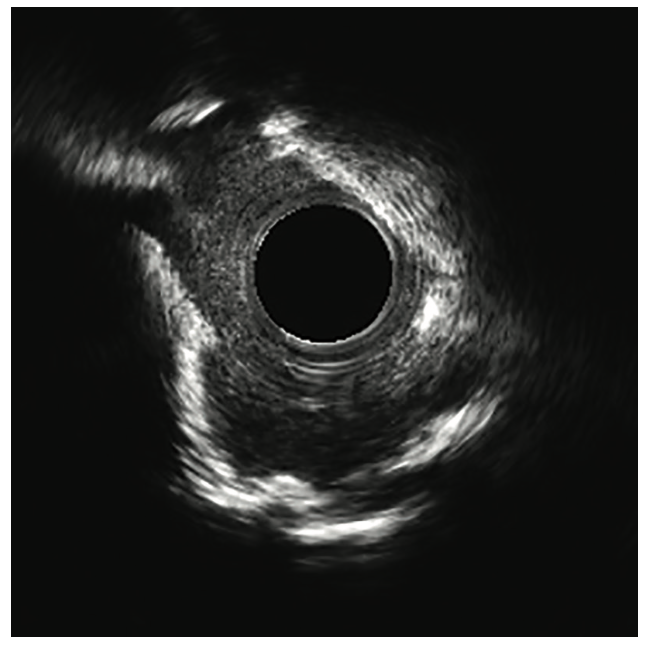 Secemsky Complex Lesions Figure 2