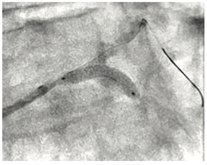 Secemsky Complex Lesions Figure 3