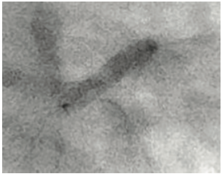 Secemsky Complex Lesions Figure 4
