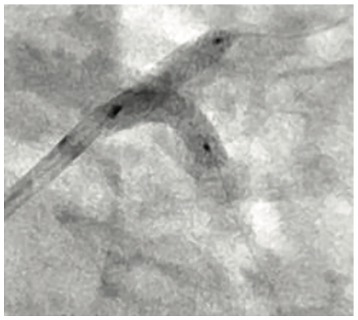 Secemsky Complex Lesions Figure 5