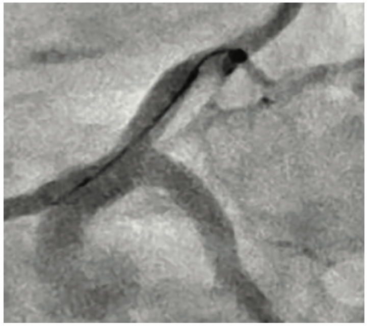 Secemsky Complex Lesions Figure 6