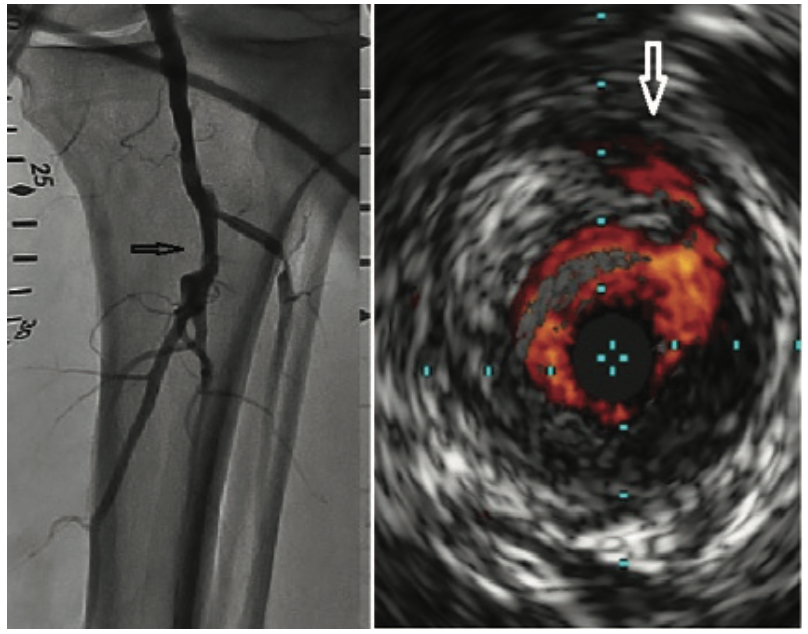 Secemsky Intravascular Ultrasound Figure 1
