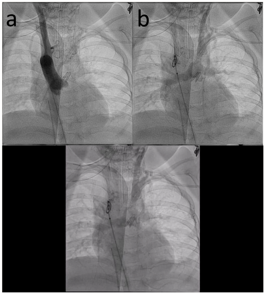 Seckeler Aorto-pulmonary Shunt Figure 1AB