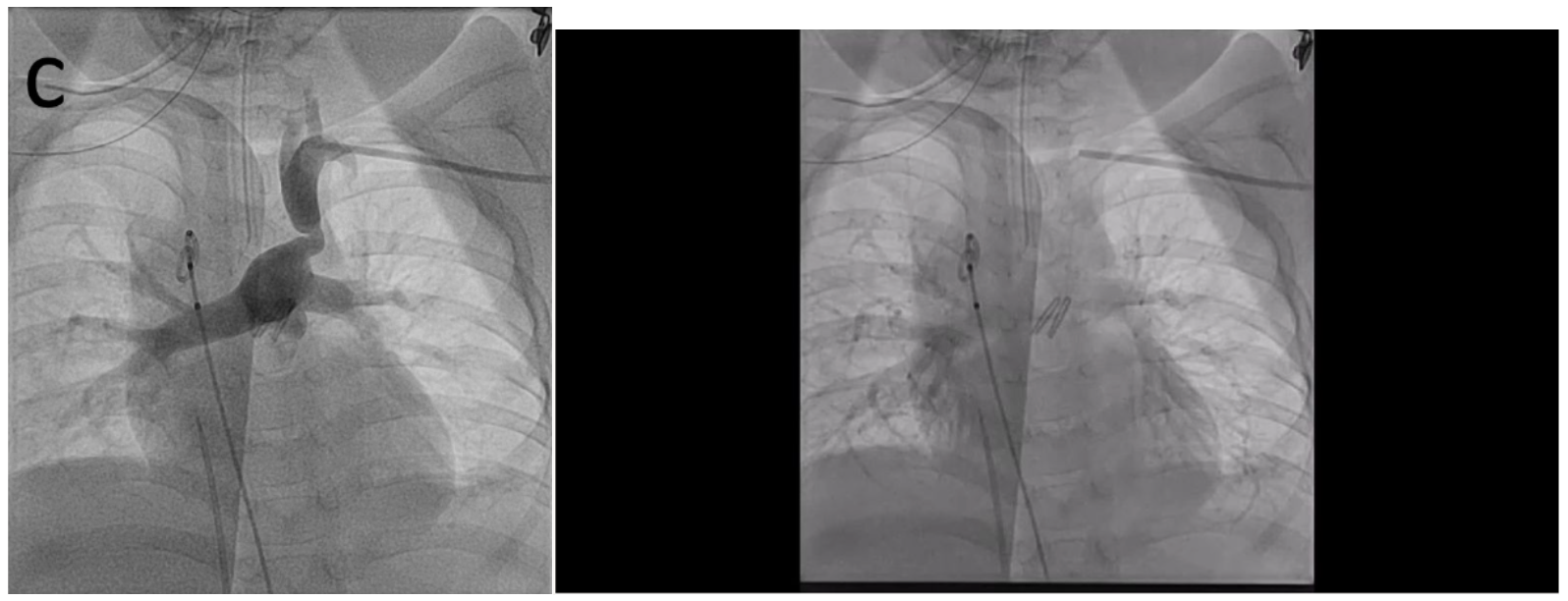 Seckeler Aorto-pulmonary Shunt Figure 1C