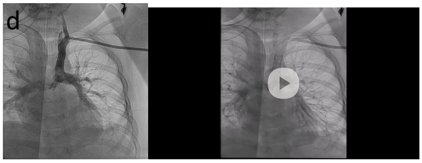 Seckeler Aorto-pulmonary Shunt Figure 1D