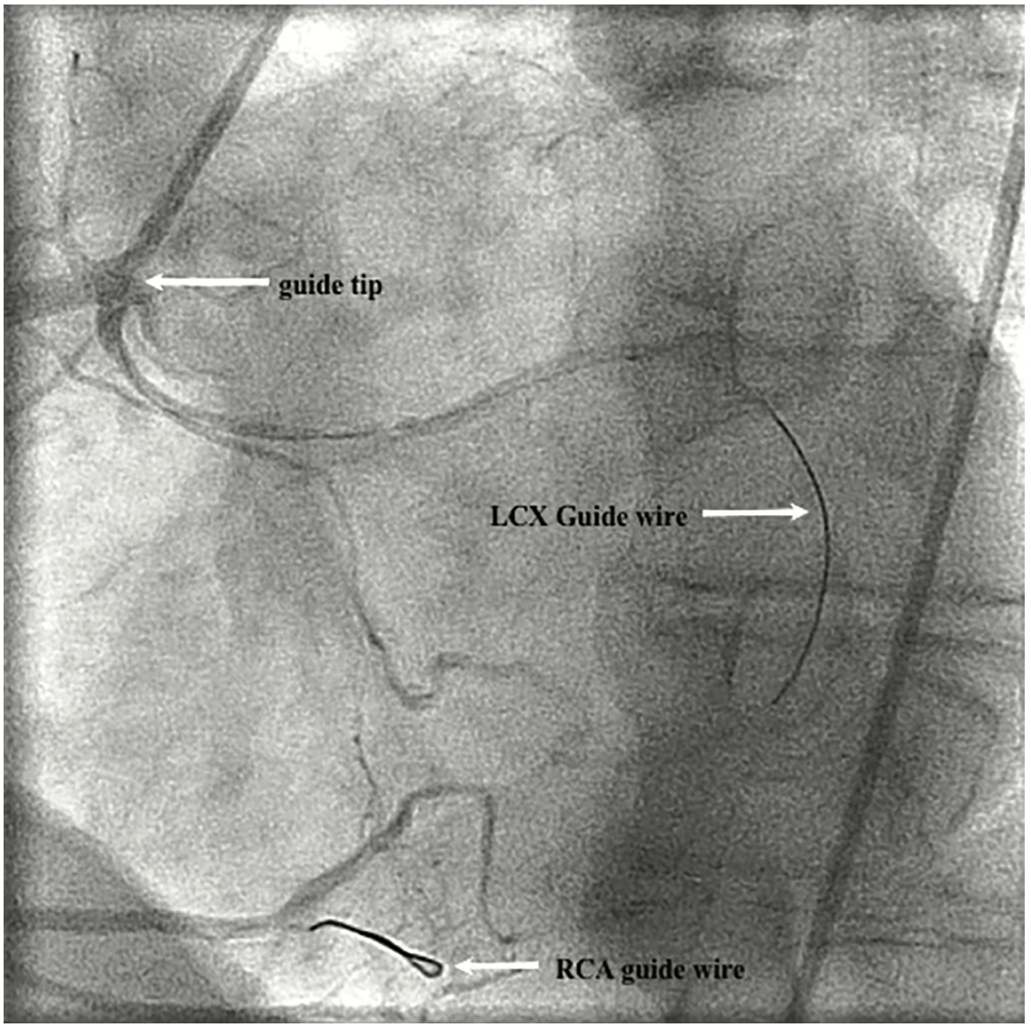 Sethi Left Circumflex Figure 4