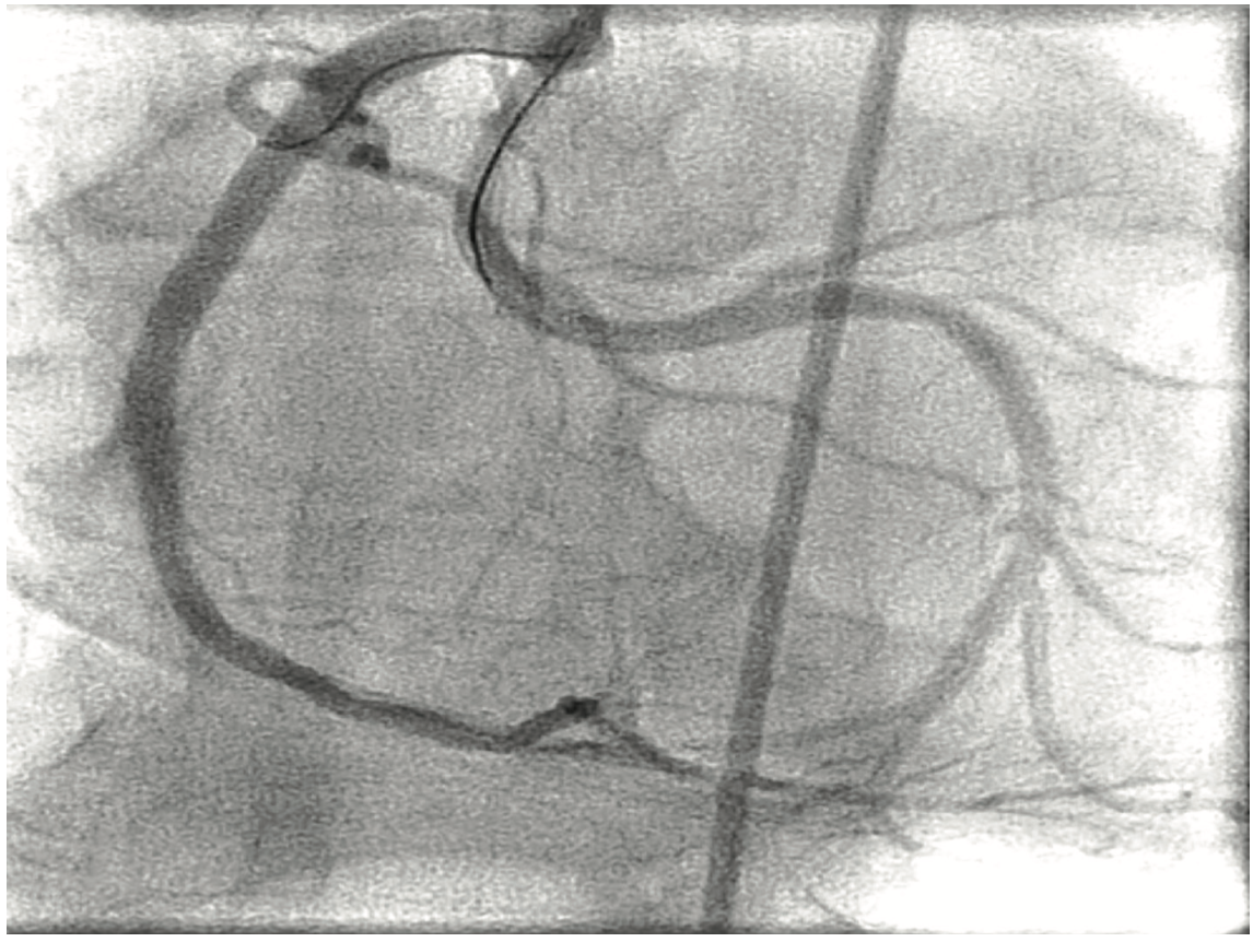Sethi Left Circumflex Figure 5
