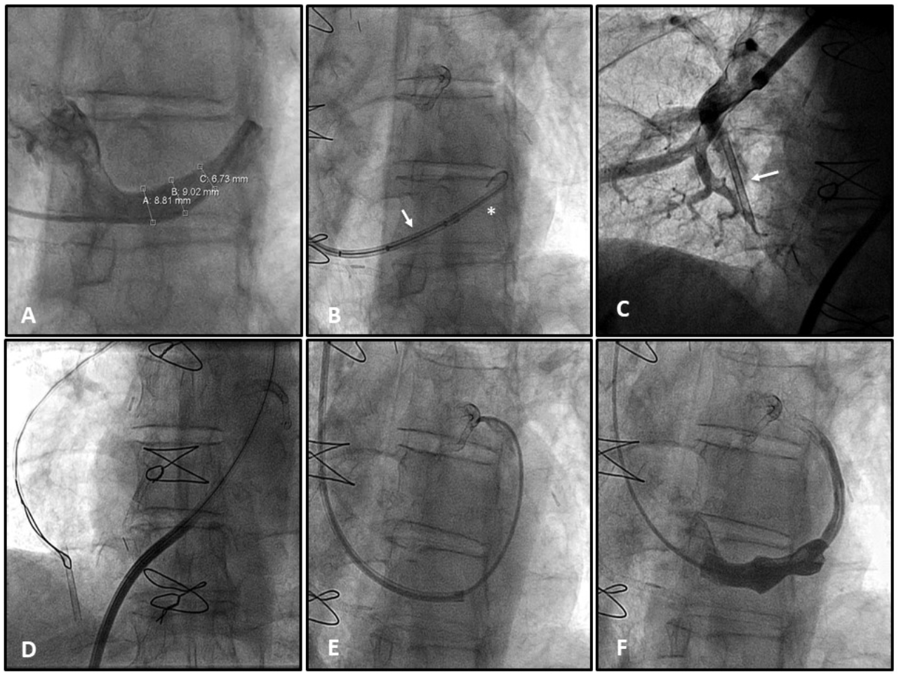 Severo Coronary Sinus Reducer Figure 1