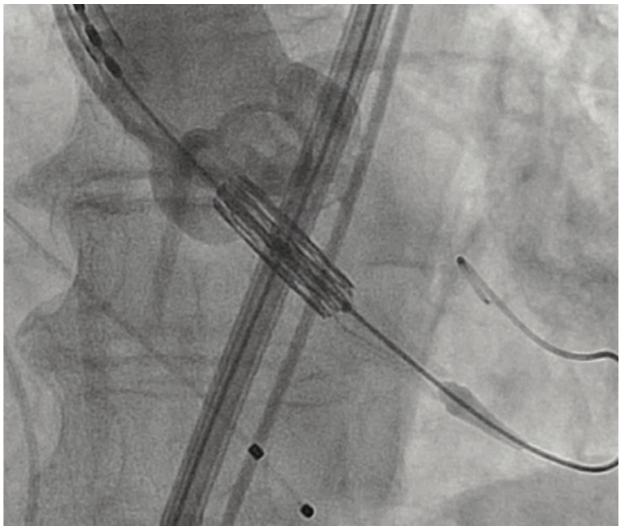 Shah Aortic Valve Figure 1