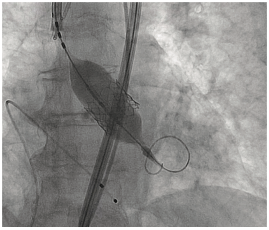 Shah Aortic Valve Figure 2