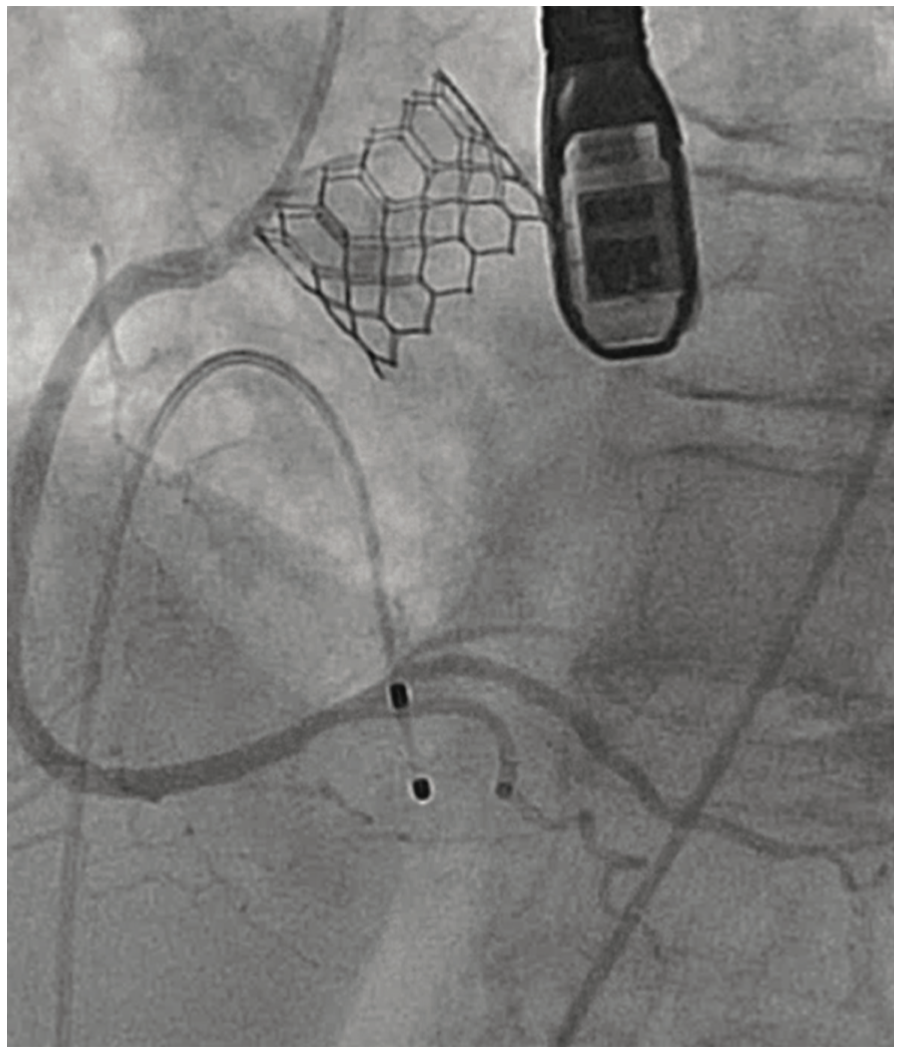 Shah Aortic Valve Figure 3