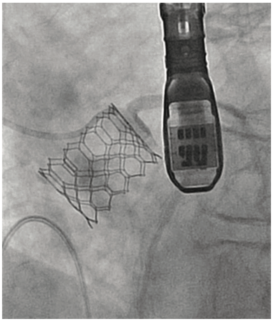 Shah Aortic Valve Figure 4