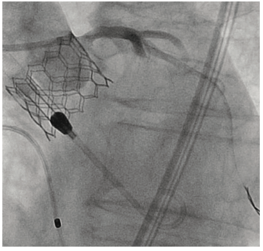 Shah Aortic Valve Figure 5