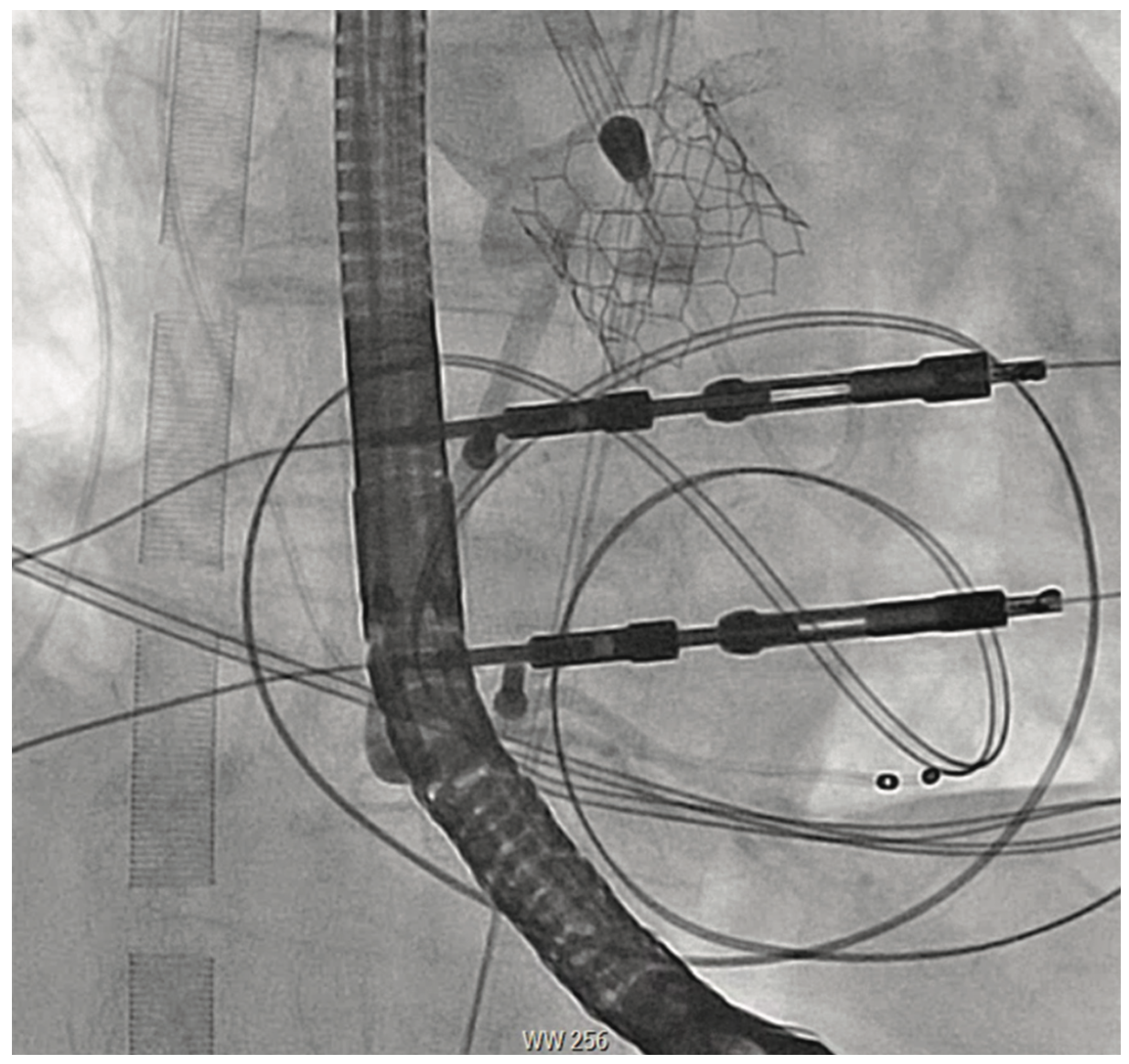 Shah Aortic Valve Figure 6