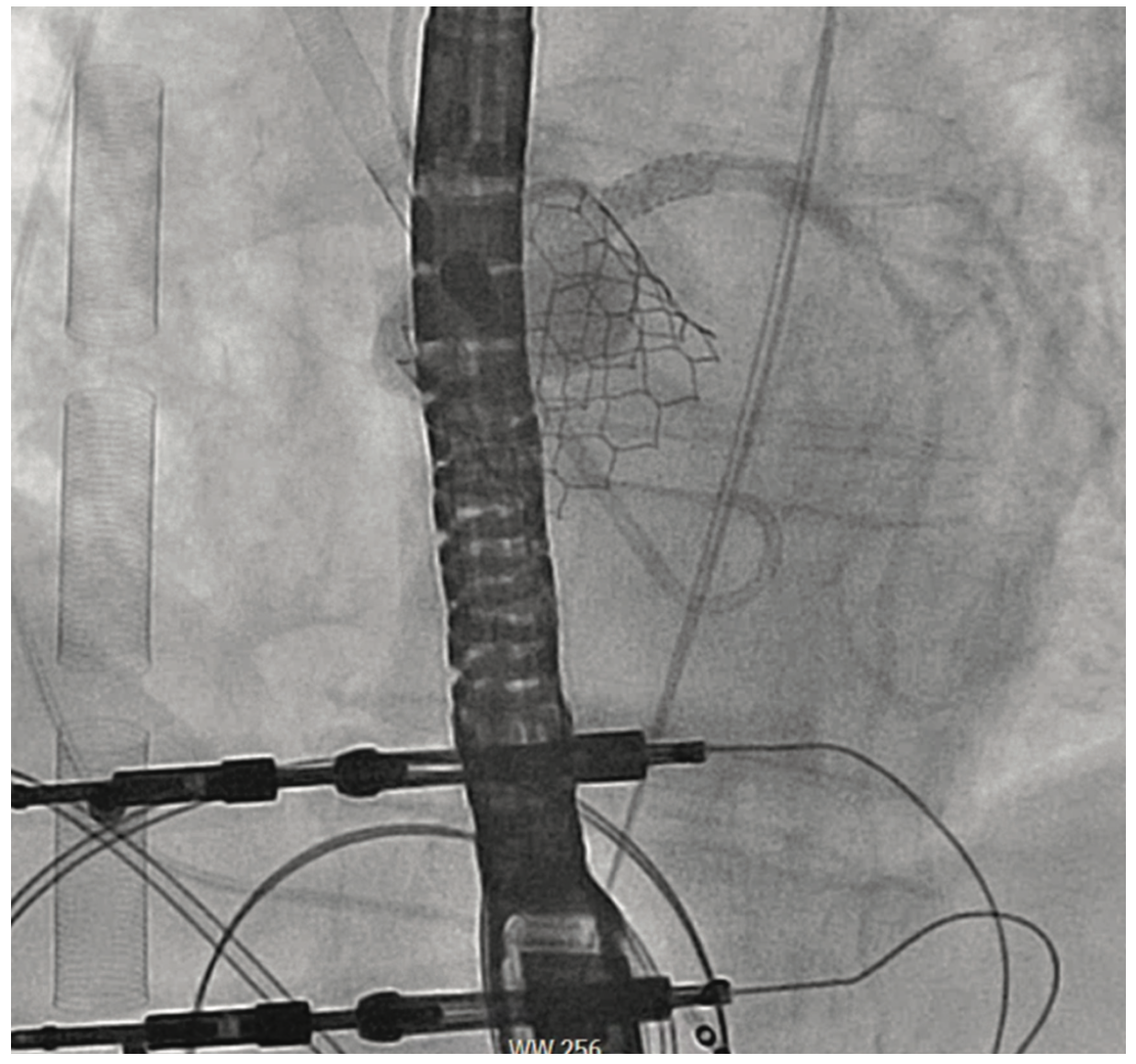 Shah Aortic Valve Figure 7