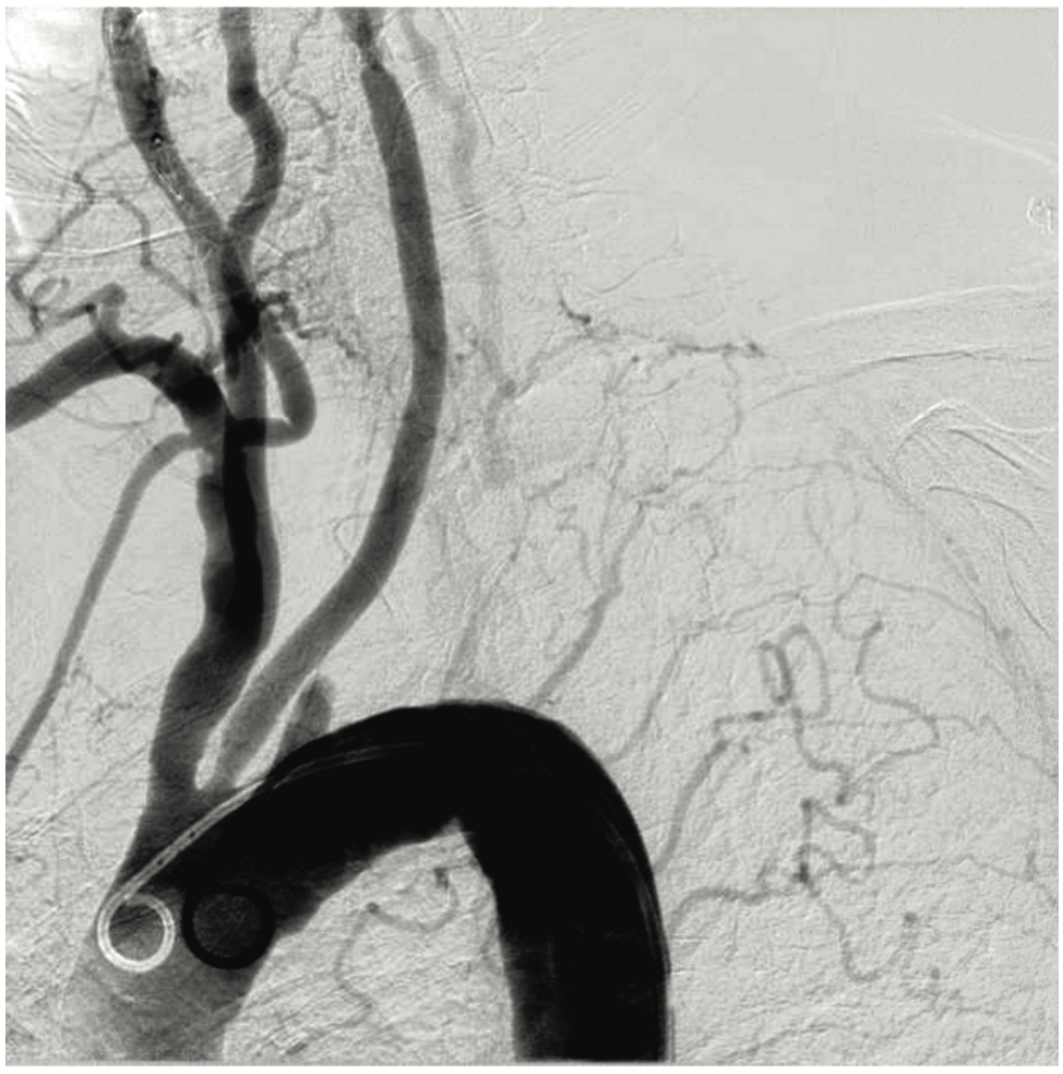 Shah Subclavian Steal Syndrome Figure 1
